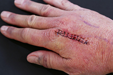 Wound information Stitches