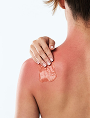 Wound information Sunburns